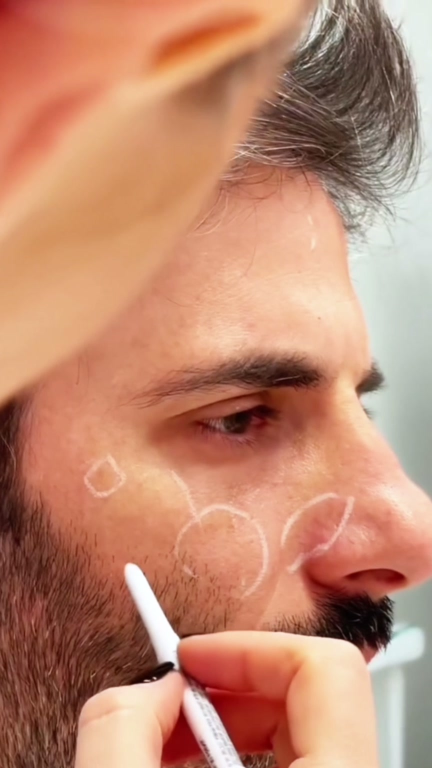 Marcação de planejamento facial em peça de procedimento